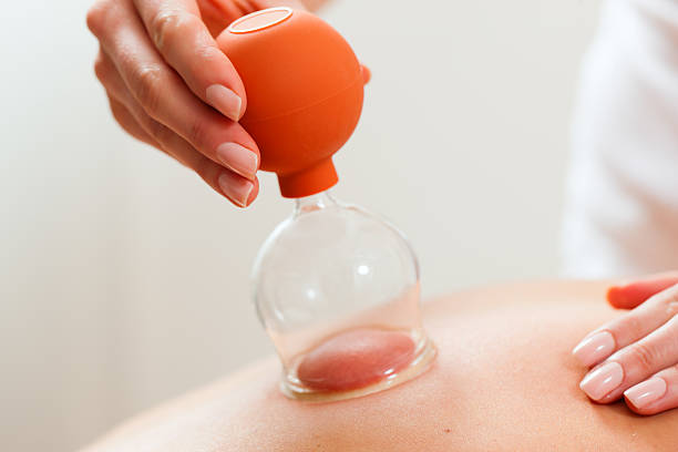 Patient at the physiotherapy - cupping stock photo