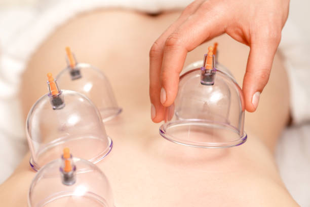 뒷면에 의료 용 컵을 진공 청소기로 청소하십시오. - acupuncture cupping 뉴스 사진 이미지