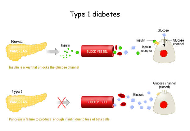 Types 1 of Diabetes Mellitus Types 1 of Diabetes Mellitus. Pancreas's failure to produce  enough insulin due to loss of beta cells. Insulin is a key that unlocks the glucose channel. The absorption of glucose by the cell. Infographic. Vector illustration glycogen stock illustrations