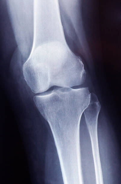 image de rayon x du genou - fémur et tibia - x ray human knee orthopedic equipment human bone photos et images de collection