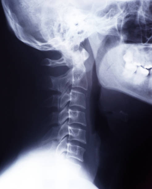 목과 경부 척추의 엑스레이, 측면, 측면도 - orthopedic equipment osteoporosis x ray human spine 뉴스 사진 이미지