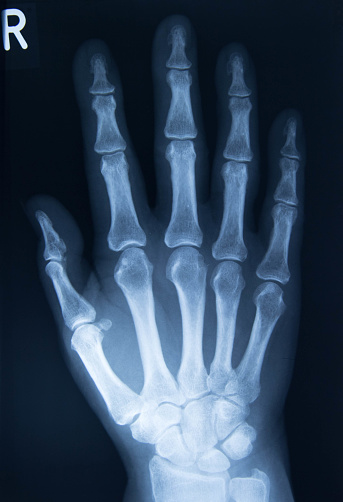 xray image of hand AP view isolated on black background for diagnostic rheumatoid.