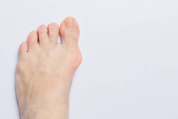 bunion prima della rimozione chirurgica. bunion a lato di un piede isolato su sfondo bianco grigio - misalignment foto e immagini stock