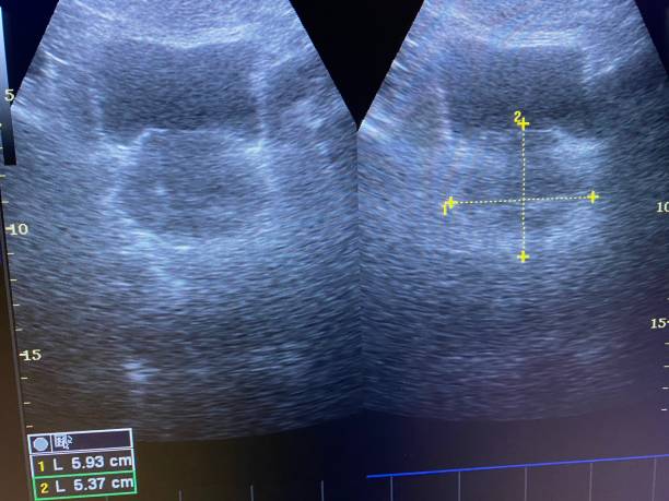 image de la prostate humaine agrandie sur l’écran d’ultrason - prostate gland photos et images de collection