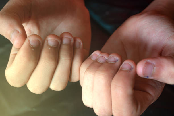 bite the nails. a hand with some ugly nails - nail biting imagens e fotografias de stock