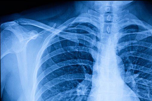 Película de rayos X de la cavidad torácica humana photo