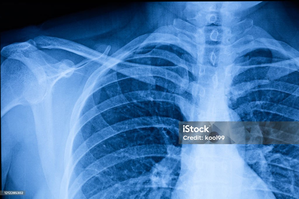 Human Thoracic cavity X-ray Film X-ray Image Stock Photo