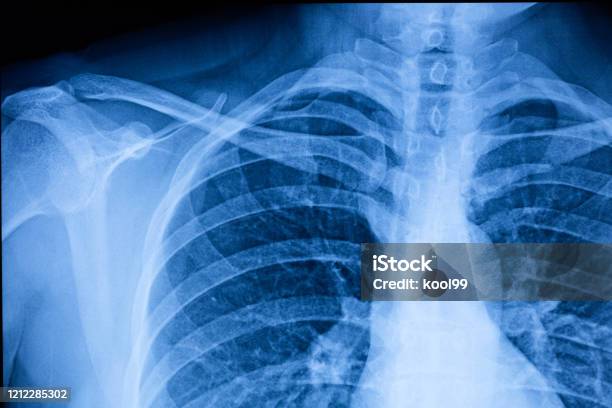 Human Thoracic Cavity Xray Film Stock Photo - Download Image Now - X-ray Image, X-ray Equipment, Lung