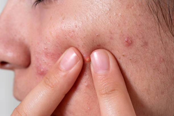 istock teenage girl skin problems during adolescence 1212320112