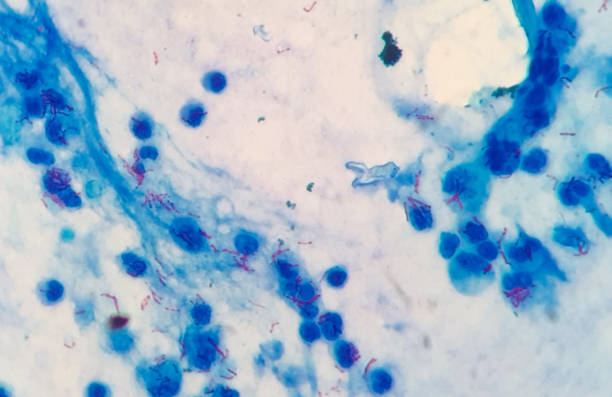 Ziehl-Neelsen Stain on a patient with advanced pulmonary Tuberculosis and  AIDS. You can see many TBC bacillus in the image.