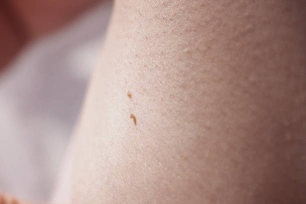 Medical skin problems. Small papillomas on the female skin. stock photo
