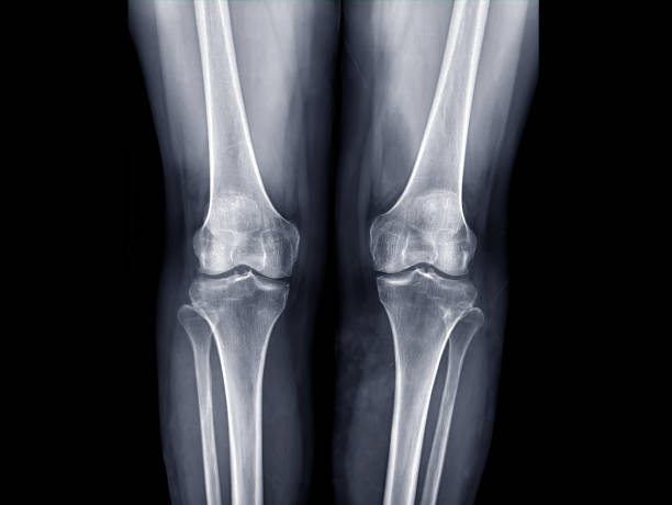 image de rayon x de la vue ap de genou pour détecter le genou d’ostéoarthrite ou le genou d’oa. - col du fémur photos et images de collection