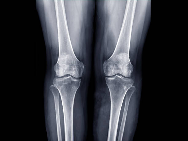 x-ray image of  both knee AP view for detect Osteoarthritis Knee or OA Knee . x-ray image of  both knee AP view for detect Osteoarthritis Knee or OA Knee . femur photos stock pictures, royalty-free photos & images