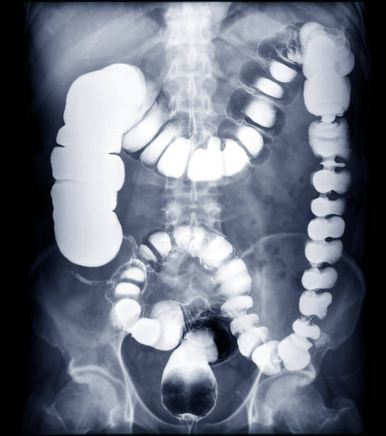 バ�リウム浣腸画像の選択的焦点または大腸のx線画像 - barium ストックフォトと画像