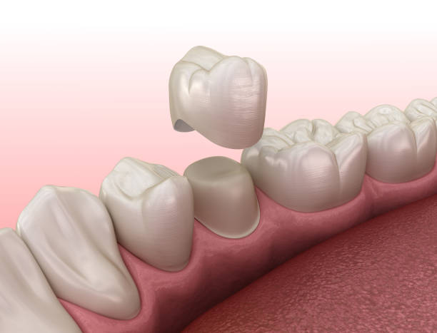 istock Preparated premolar tooth and dental crown placement. Medically accurate 3D illustration 1212638886