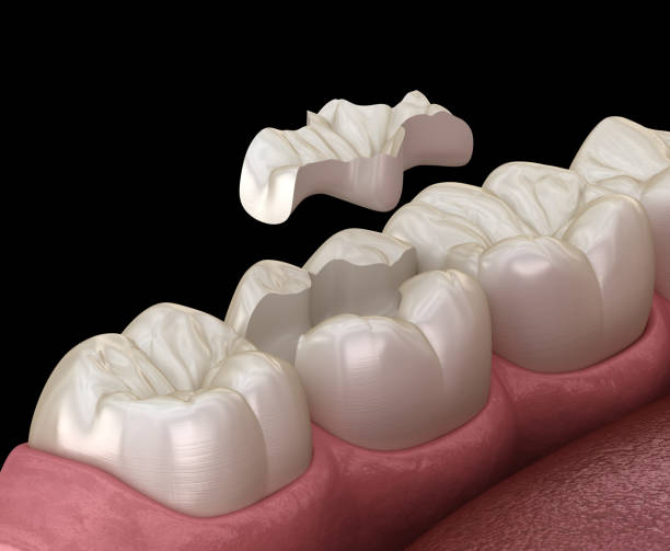 istock Inlay ceramic crown fixation over tooth. Medically accurate 3D illustration of human teeth treatment 1212638895