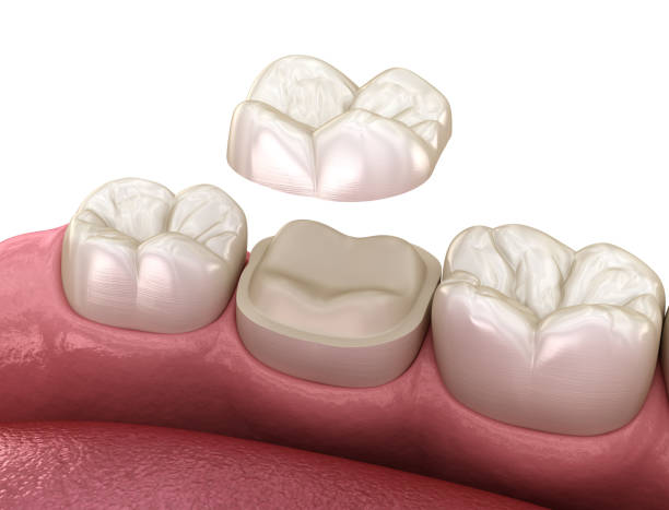 istock Preparation for Onlay ceramic crown fixation over tooth. Medically accurate 3D illustration of human teeth treatment 1212638900