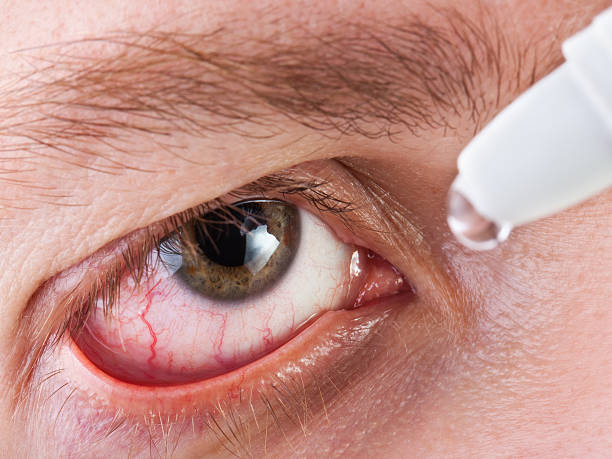 istock Man dropping medicine into eye 121266450