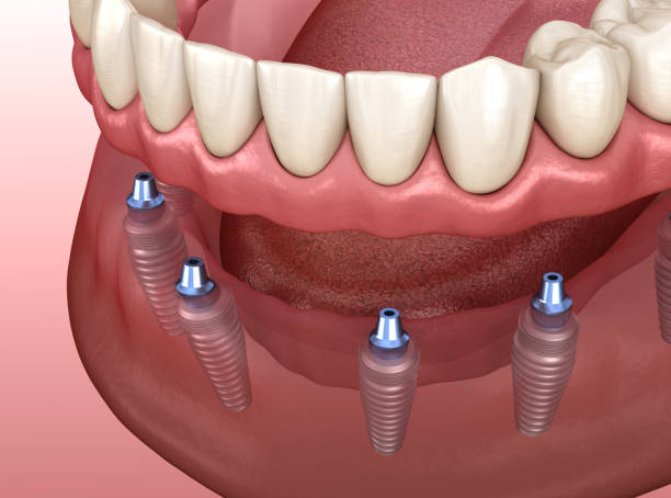 mandibular prosthesis with gum all on 6 system supported by implants.  medically accurate 3d illustration of human teeth and dentures concept - implantat imagens e fotografias de stock