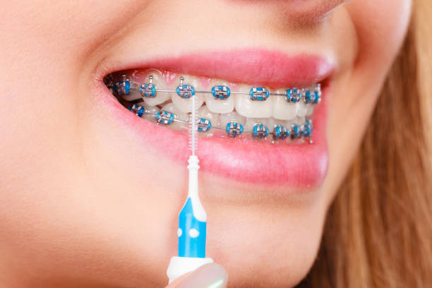 istock Woman smiling cleaning teeth with braces 1212697030