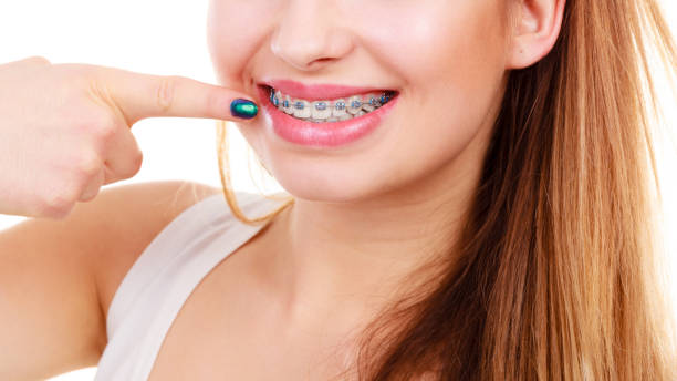 istock Woman showing her teeth with braces 1212697331