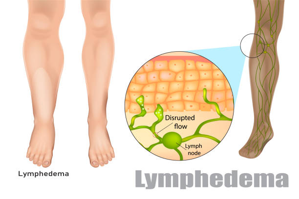 ilustrações de stock, clip art, desenhos animados e ícones de lymphedema, also known as lymphoedema and lymphatic edema - primary care