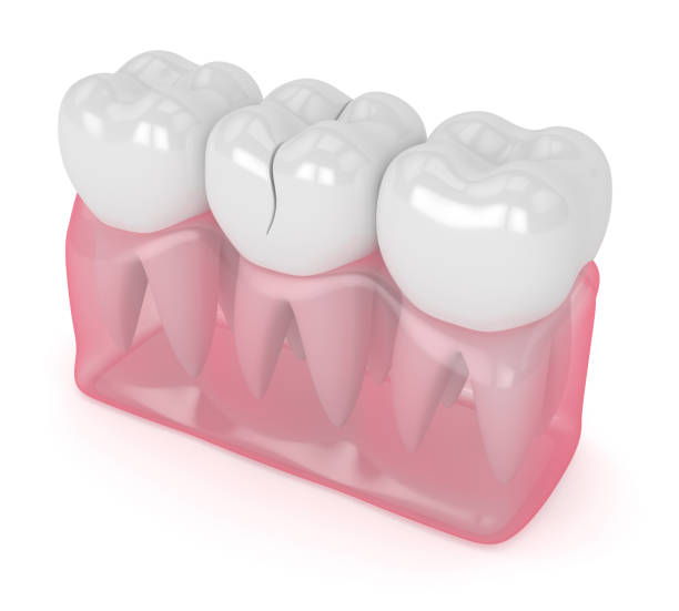 istock 3d render of jaw with cracked tooth 1212767737
