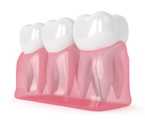 istock 3d render of gum with cracked tooth root 1212767798