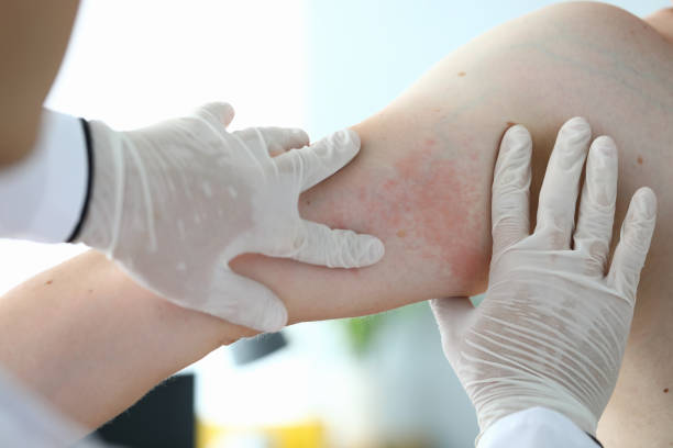 Close-up examination by doctor, allergic rash. Close-up examination by doctor allergic rash. Doctor examines patient skin. Hands in medical gloves palpating skin with red rash. Examination by dermatologist, problem with health an allergy. dermatitis photos stock pictures, royalty-free photos & images