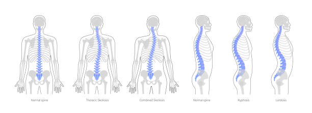 Spinal deformity flat vector illustration Spinal deformity flat vector illustration. Kyphosis, lordosis and scoliosis of spine infographics.. Body posture defect. Medical, educational and science banner kyphosis stock illustrations