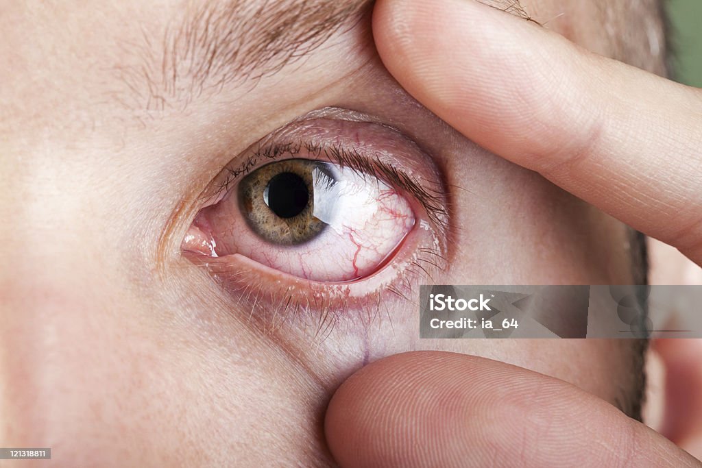 Blood capillary human eye  Eye Stock Photo