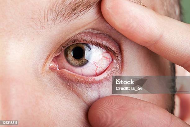 Blood Capillary Human Eye Stock Photo - Download Image Now - Eye, Dry, Allergy