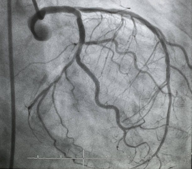 冠動脈造影 - surgery catheter cardiac catheterization hospital ストックフォトと画像