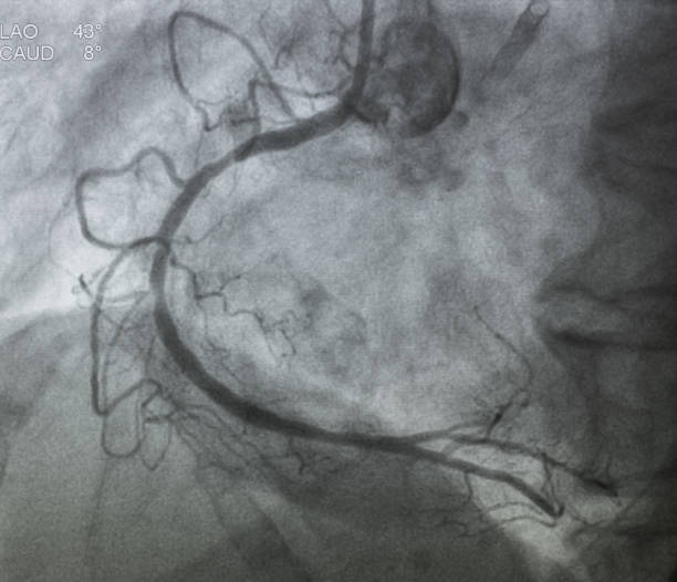 angiografía coronaria - surgery catheter cardiac catheterization hospital fotografías e imágenes de stock