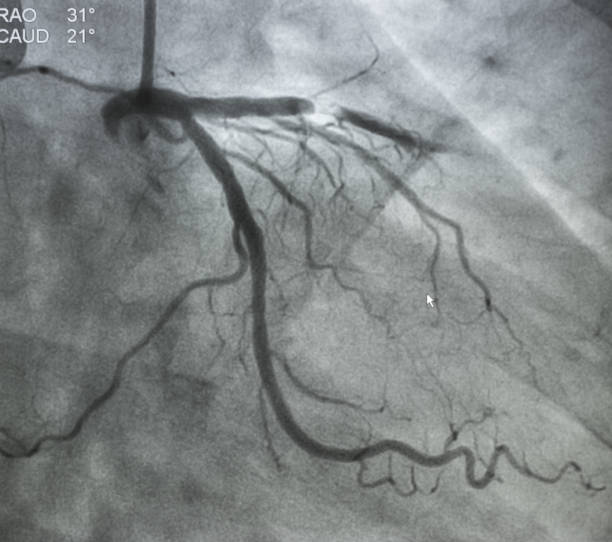 angiografía coronaria - surgery catheter cardiac catheterization hospital fotografías e imágenes de stock