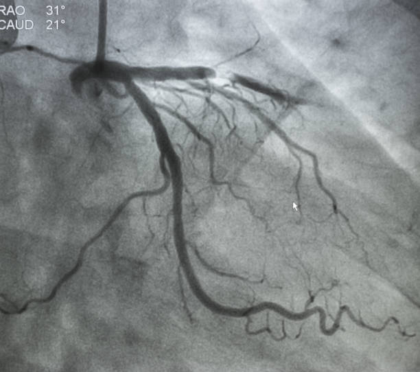 Coronary angiography stock photo