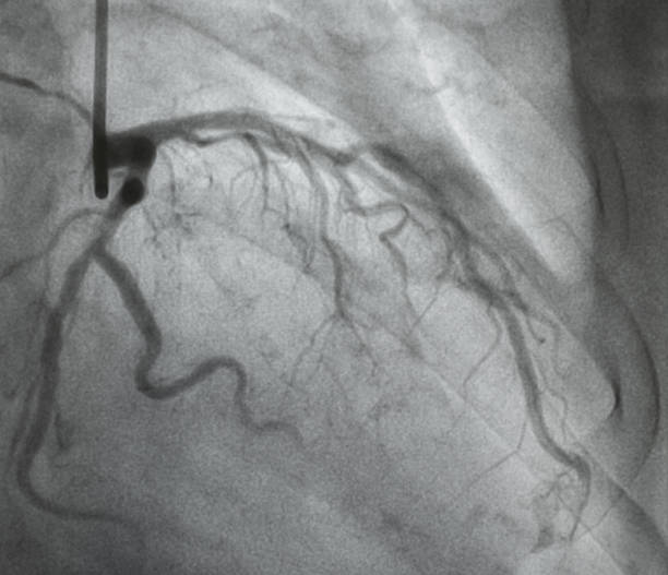 冠動脈造影 - surgery catheter cardiac catheterization hospital ストックフォトと画像