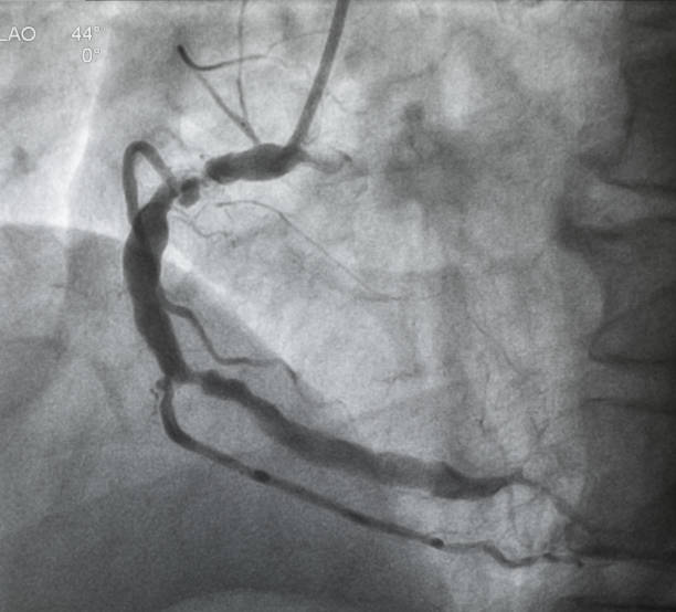 冠動脈造影 - surgery catheter cardiac catheterization hospital ストックフォトと画像