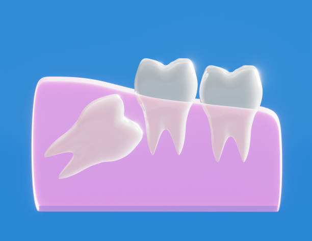 istock Wisdom tooth grows wrong, wisdom tooth problem, horizontal position of the wisdom tooth, Impacted wisdom tooth 1213259206