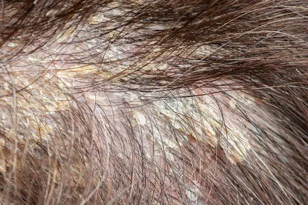 Cropped short of a woman's dandruff in the hair and scalp