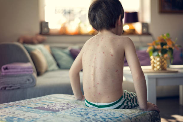 istock Boy with chickenpox at home interior 1213525140