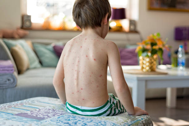 Boy with chickenpox at home interior