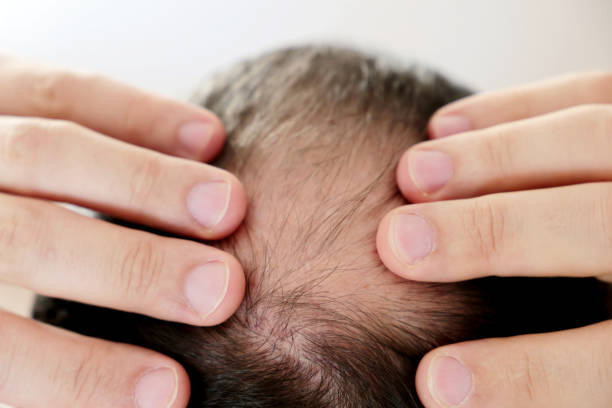 istock Baldness, man concerned about hair loss 1213552803