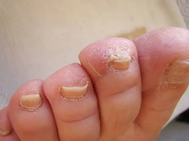 Nail fungus on your toes kind of infected nails close-up