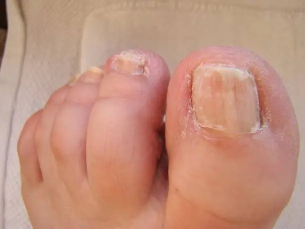 Nail fungus on your toes kind of infected nails close-up