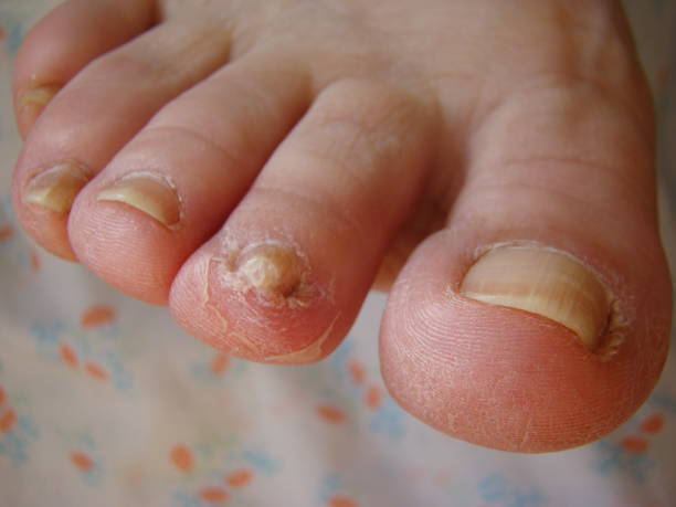 istock nail fungus 1213652672