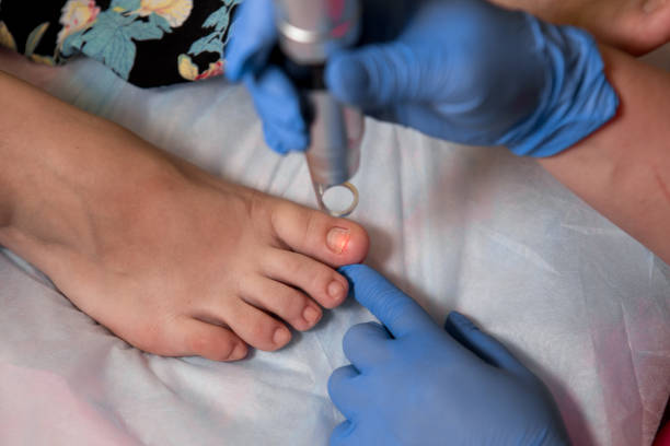 Toenail fungus treatment with foot laser at laser nail Toenail fungus treatment with foot laser at laser nail therapy clinic. - Image ringworm photos stock pictures, royalty-free photos & images