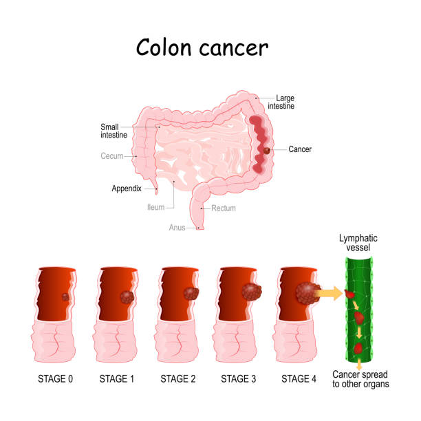 darmkrebs. kolorektalonkologie. entwicklung eines bösartigen tumors von 0 bis 4 stufen - darmspiegelung stock-grafiken, -clipart, -cartoons und -symbole
