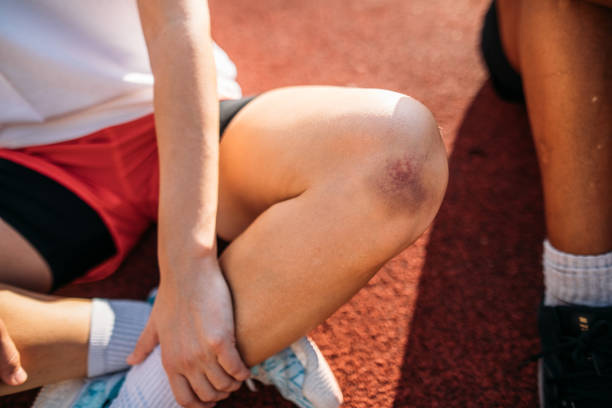 Bruised knee of a female athlete sitting on a sports court Female athlete with a bruised knee sitting on a sports court. bruise photos stock pictures, royalty-free photos & images