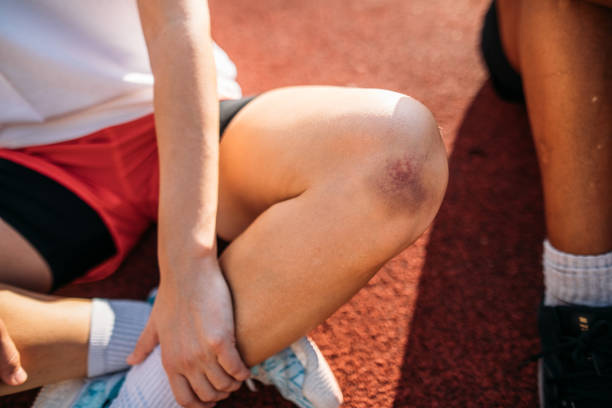 Bruised knee of a female athlete sitting on a sports court Female athlete with a bruised knee sitting on a sports court. knee contusion bruised knee stock pictures, royalty-free photos & images
